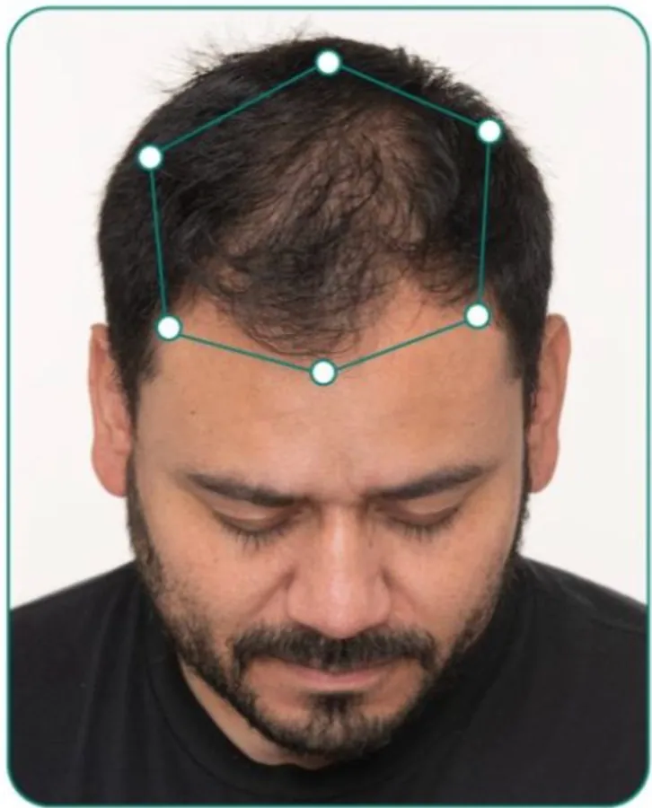 Hair restoration: before