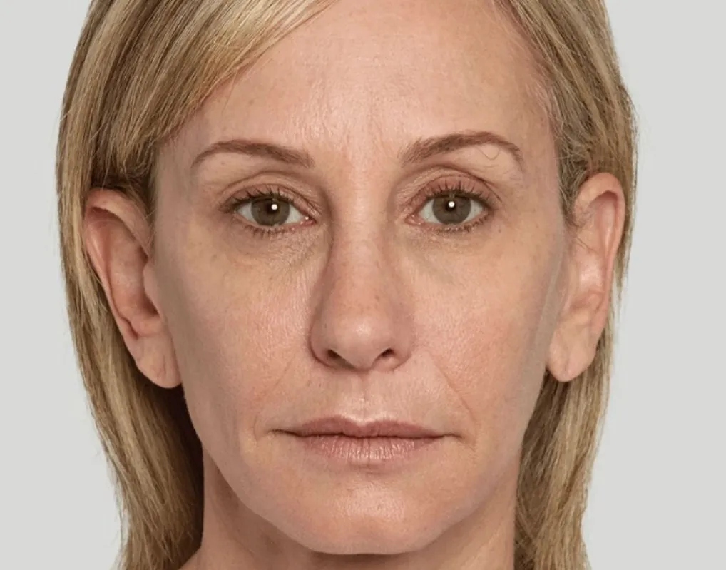 Facial Sculptra: after