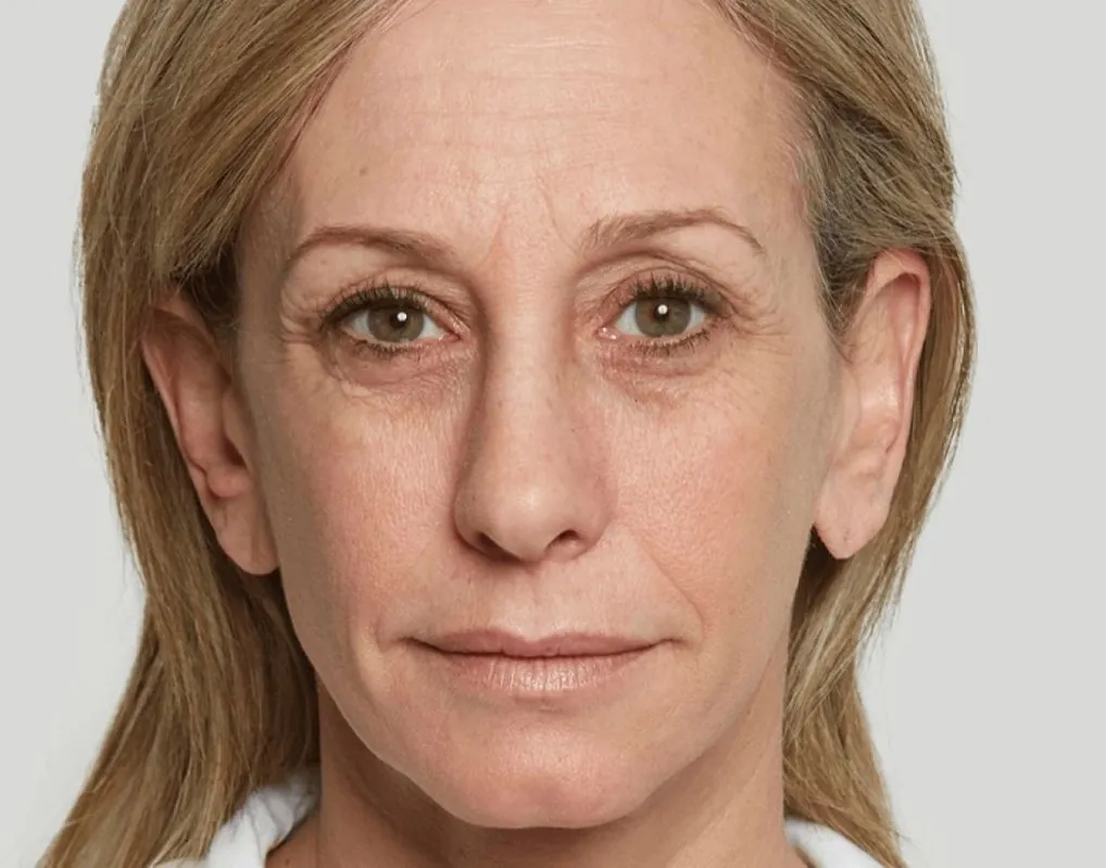 Facial Sculptra: before