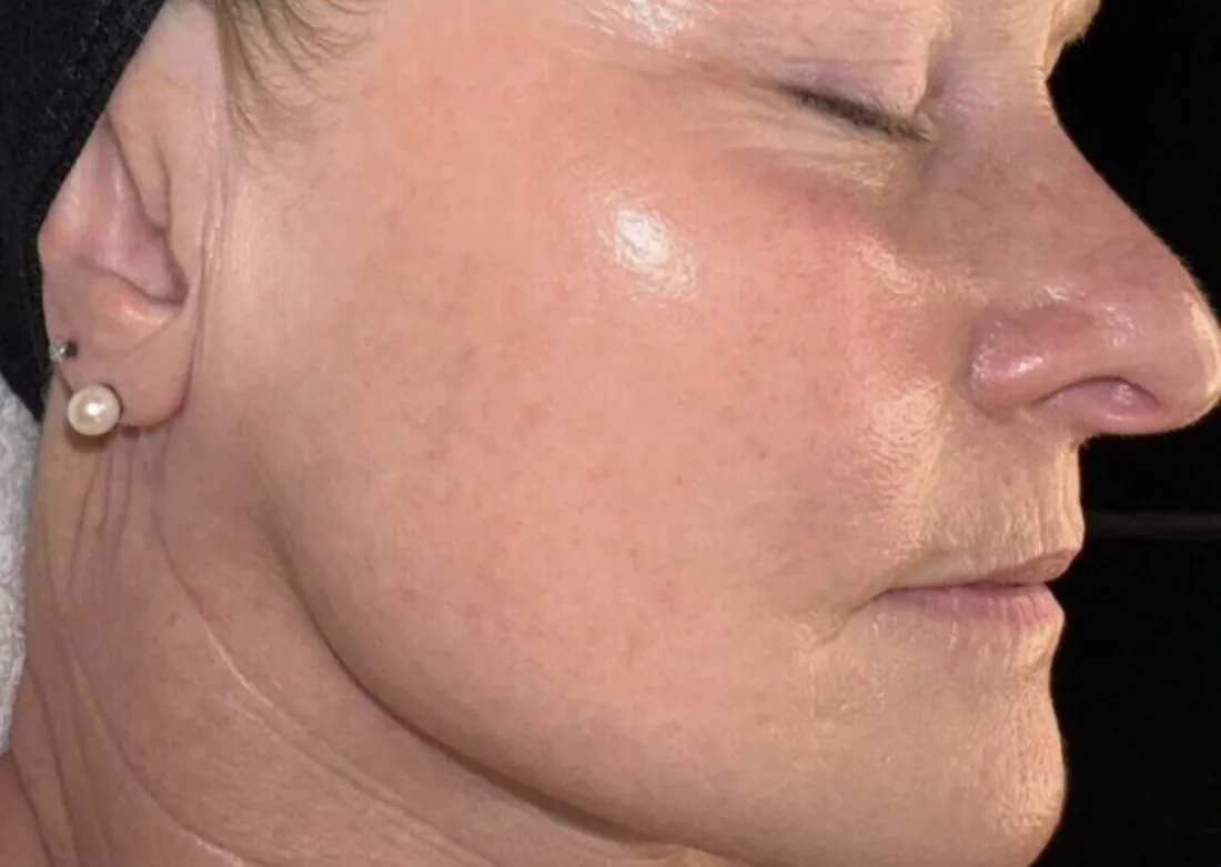 Texture &amp; fine lines: after