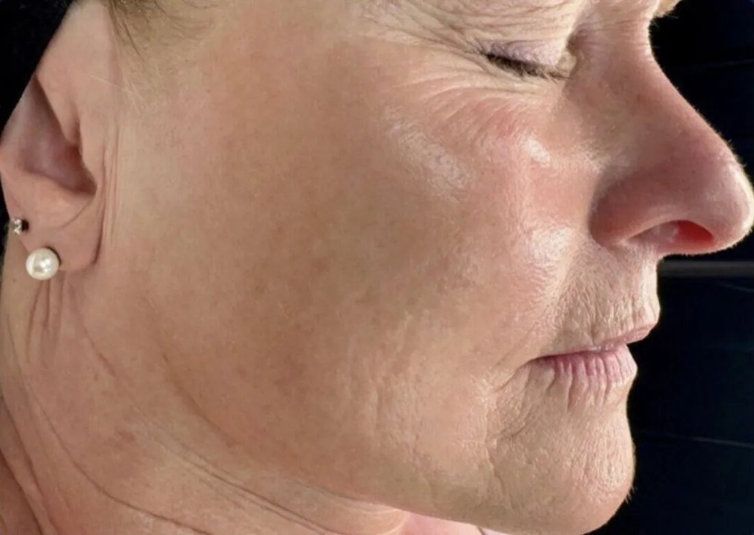 Texture &amp; fine lines: before