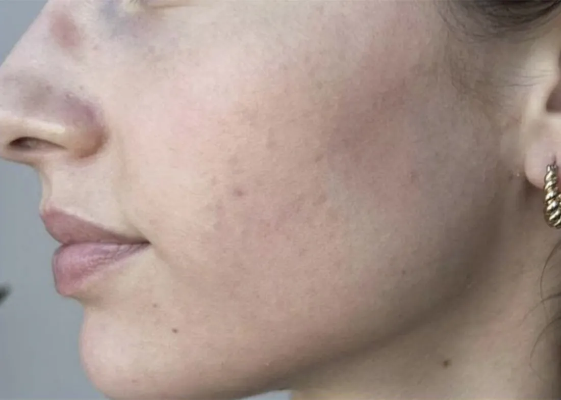 SkinPen microneedling: after