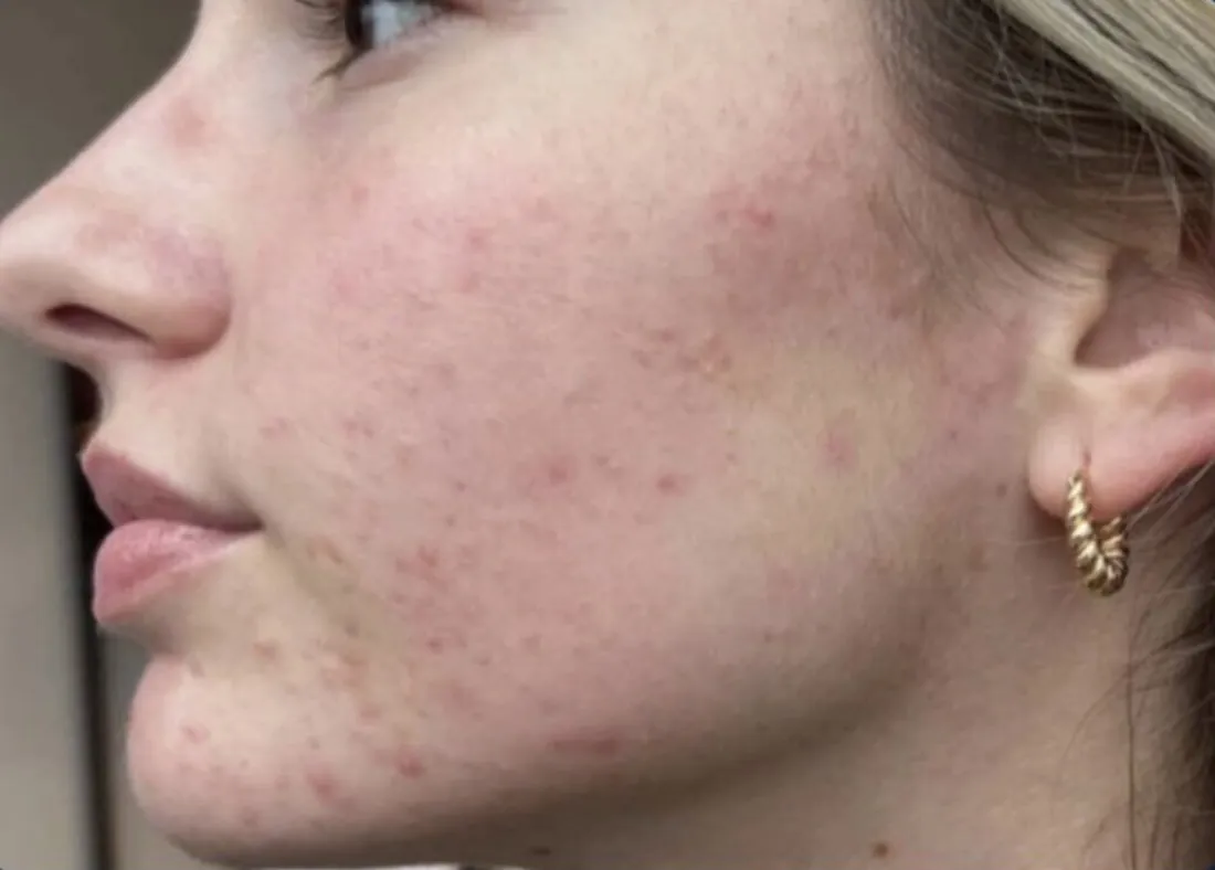 SkinPen microneedling: before