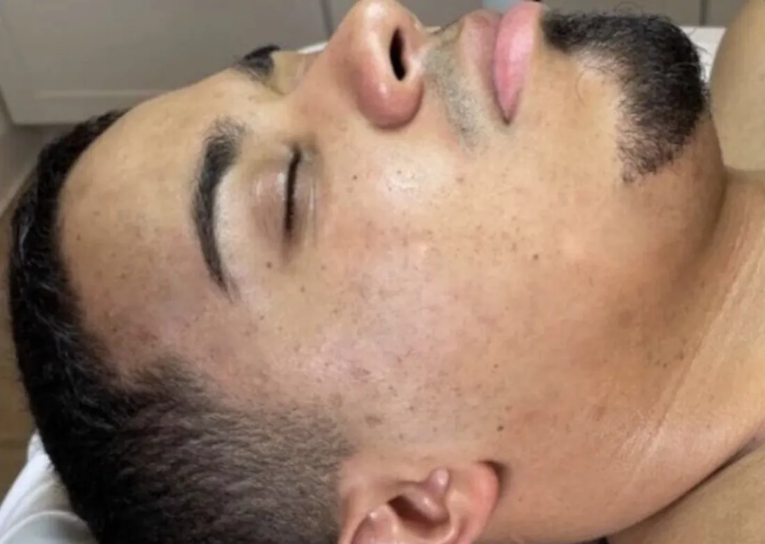 Acne marks: after