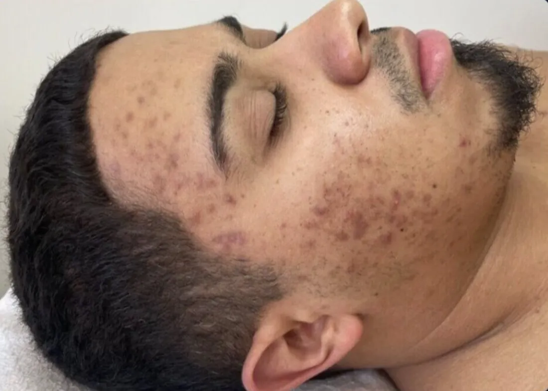 Acne marks: before