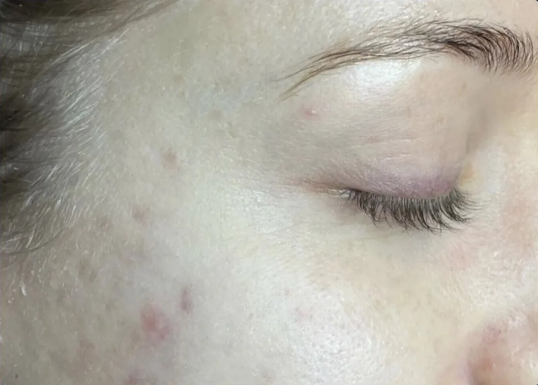 Active acne &amp; marks: after