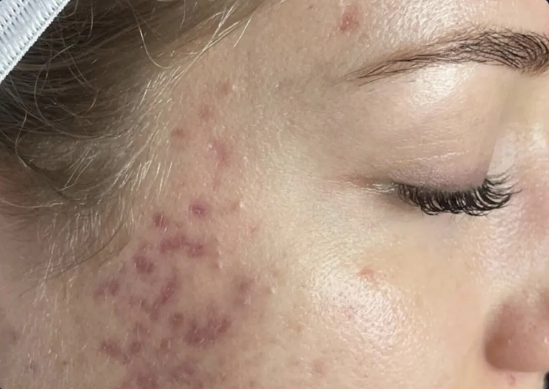 Active acne &amp; marks: before