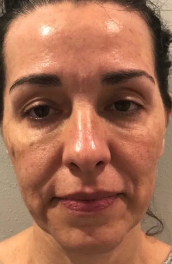 Patient result: before