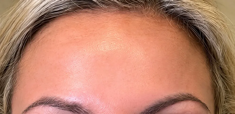 Forehead lines: after