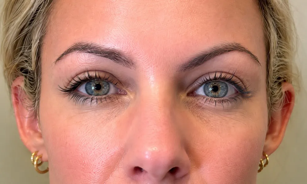 Frown lines: after
