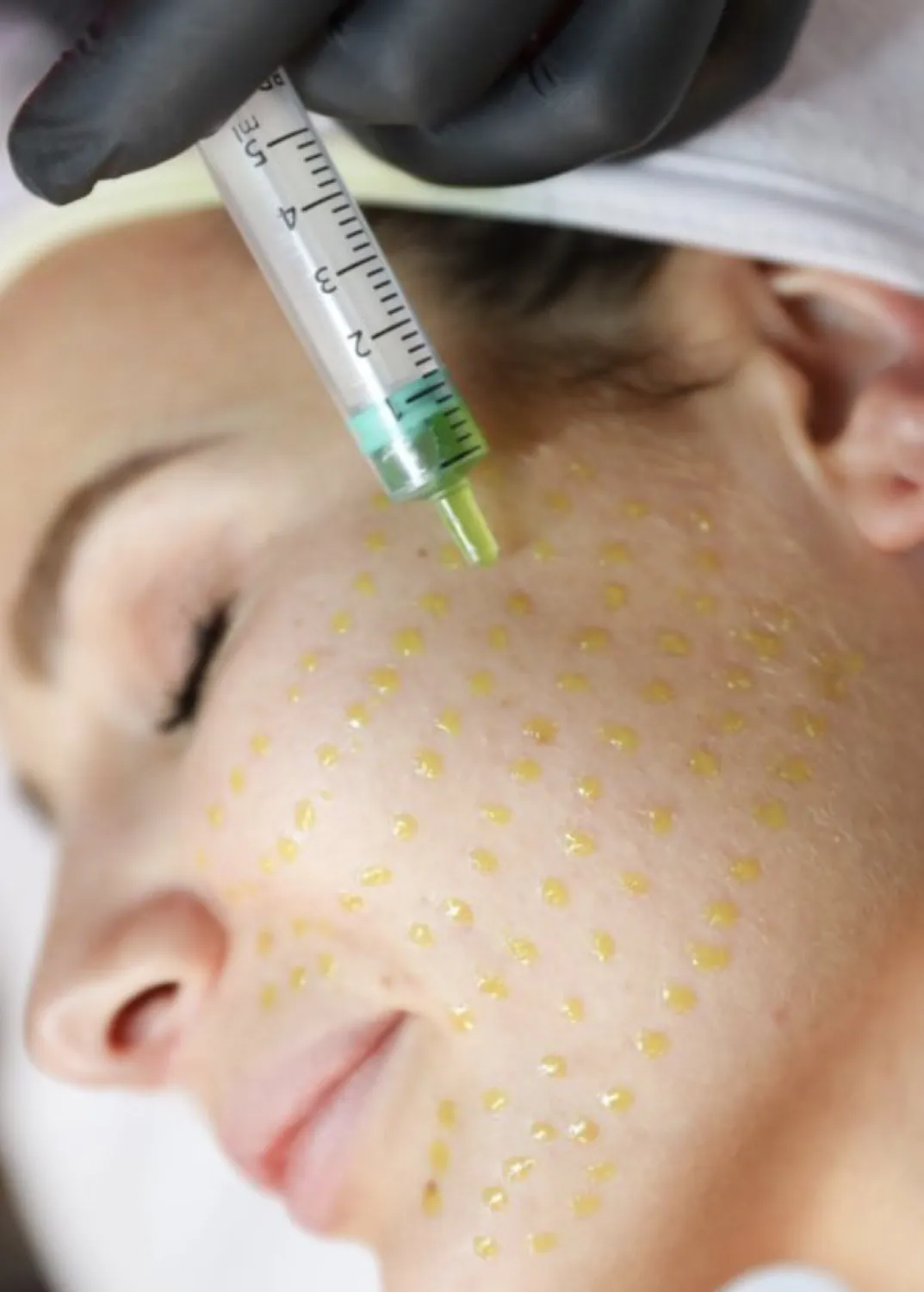 A clinician applying a peel solution to a woman’s cheek with a dropper