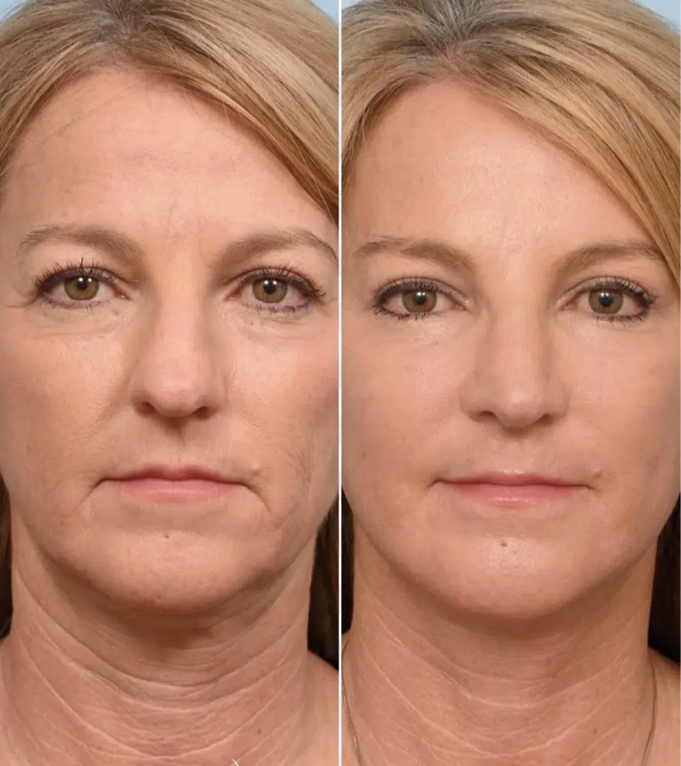 Before and after comparison of a woman’s face showing smoother, fuller-looking skin